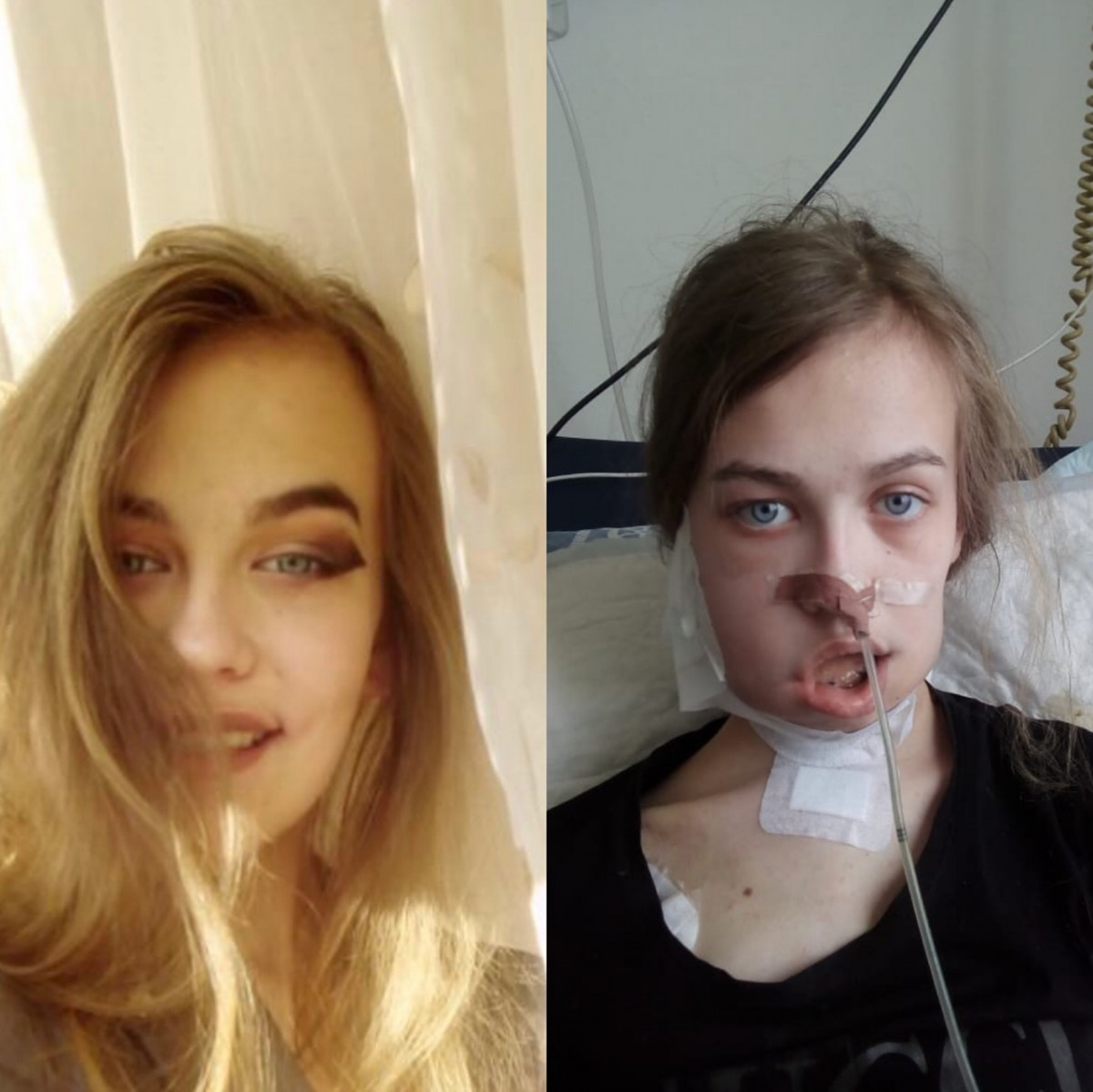 София Сидорова - одна из многих детей,чью жизнь удалось спасти,благодаря слаженной работе МЗ ДНР,МЗ РФ и центра им.Дмитрия Рогачёва г. Москвы1615807931