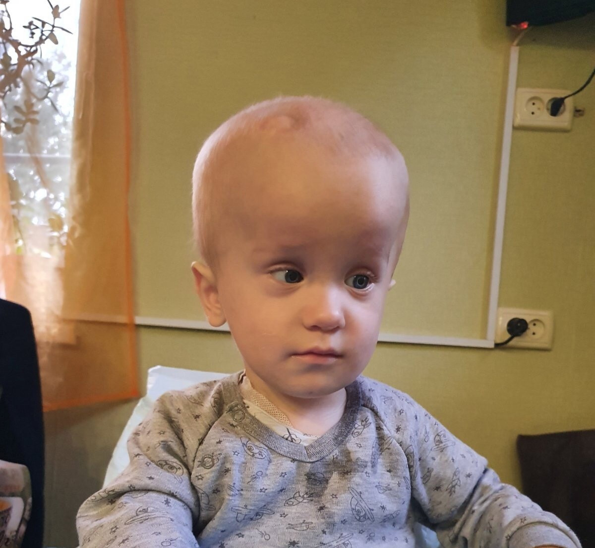 Пилоцитарная астроцитома с метастазами - неоперабельная опухоль, из-за которой слепнет годовалый Женя Журавлёв.1641415244